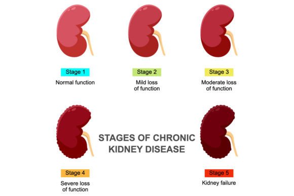 Stages of Chronic Kidney Disease Graphics Review